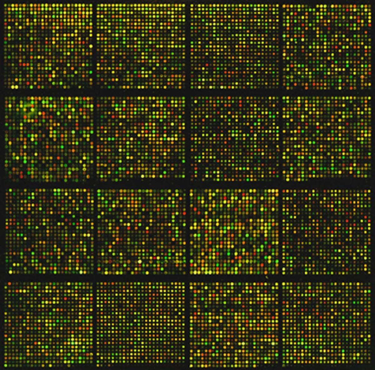 High-density peptide microarray chip showing fluorescent signal patterns for biomarker analysis